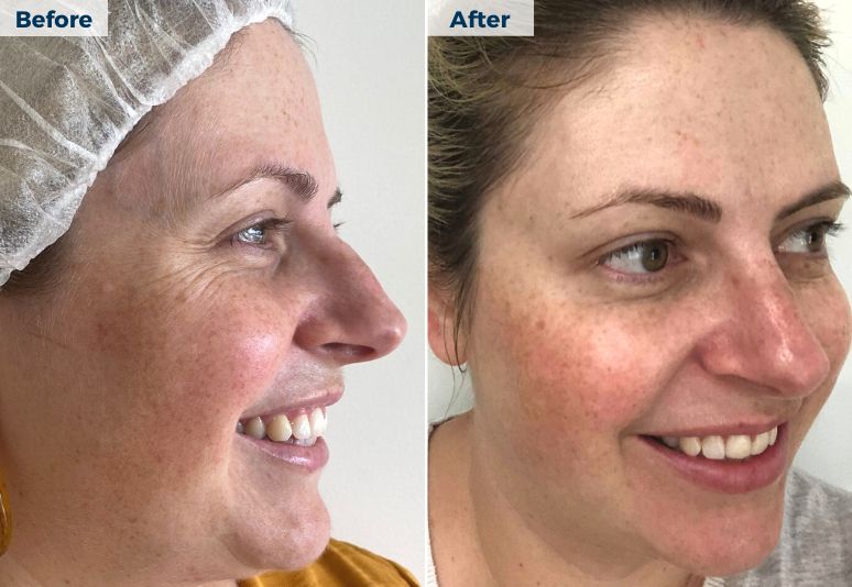 NanoNeedling National Skin Cancer Centres